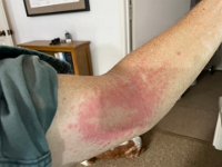 Stephen did not like what he saw in the garden (a date palm thorn scratch) as it led to 10 days of probable contact dermatitis